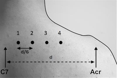 <mark class="highlighted">Eccentric Exercise</mark> Reduces Upper Trapezius Muscle Stiffness Assessed by Shear Wave Elastography and Myotonometry